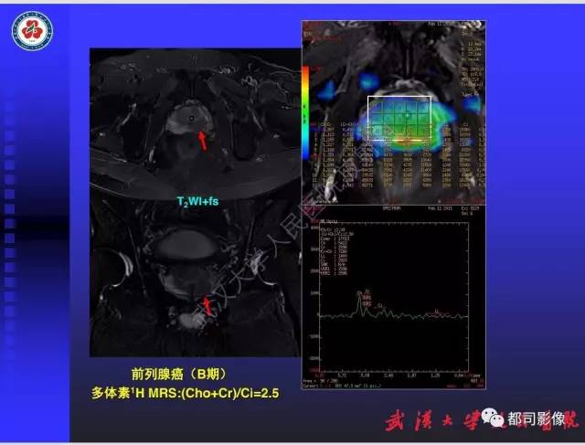 【PPT】泌尿系病变CT&MRI新技术及临床应用