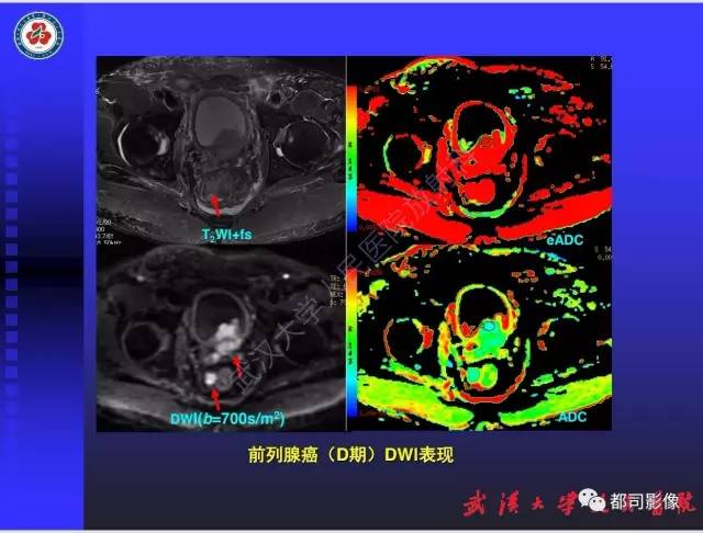 【PPT】泌尿系病变CT&MRI新技术及临床应用