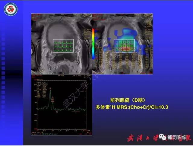 【PPT】泌尿系病变CT&MRI新技术及临床应用