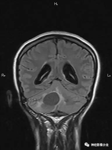 【病例】后颅窝两例囊实性病变——毛星VS血管母 【病例】后颅窝两例囊实性病变——毛星VS血管母