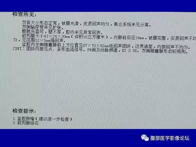 【病例】盆腔胃肠道间质瘤1例CT影像表现 【病例】盆腔胃肠道间质瘤1例CT影像表现