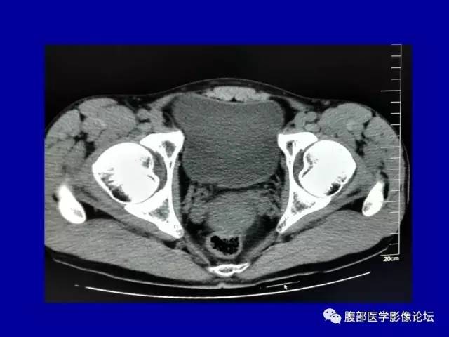 【病例】盆腔胃肠道间质瘤1例CT影像表现 【病例】盆腔胃肠道间质瘤1例CT影像表现