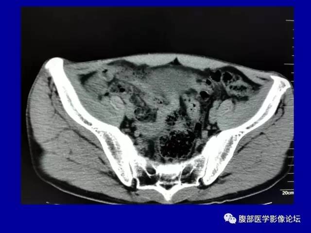 【病例】盆腔胃肠道间质瘤1例CT影像表现 【病例】盆腔胃肠道间质瘤1例CT影像表现