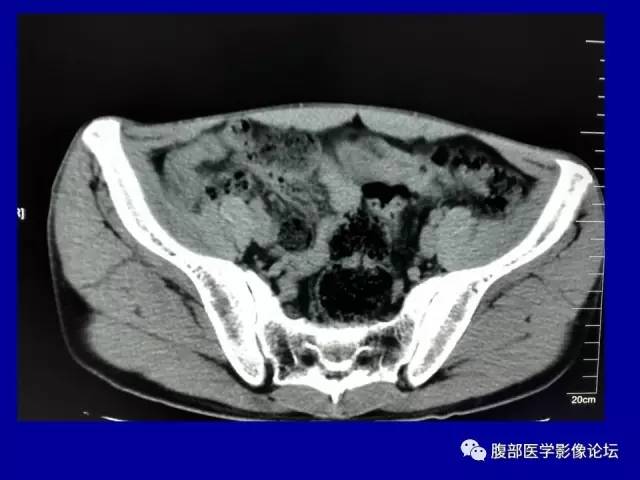 【病例】盆腔胃肠道间质瘤1例CT影像表现 【病例】盆腔胃肠道间质瘤1例CT影像表现