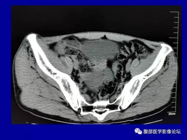 【病例】盆腔胃肠道间质瘤1例CT影像表现 【病例】盆腔胃肠道间质瘤1例CT影像表现