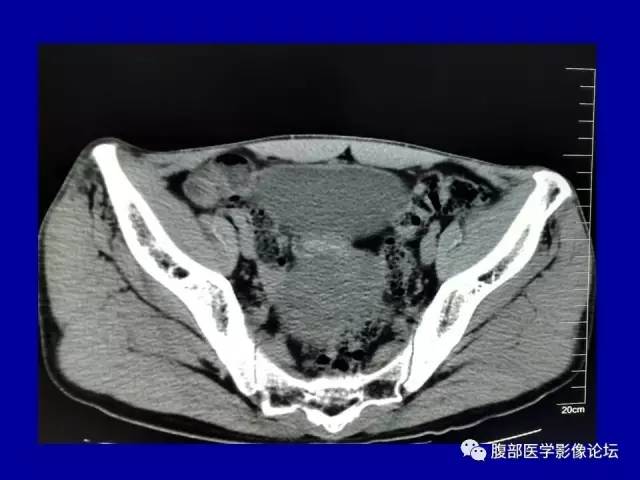 【病例】盆腔胃肠道间质瘤1例CT影像表现 【病例】盆腔胃肠道间质瘤1例CT影像表现