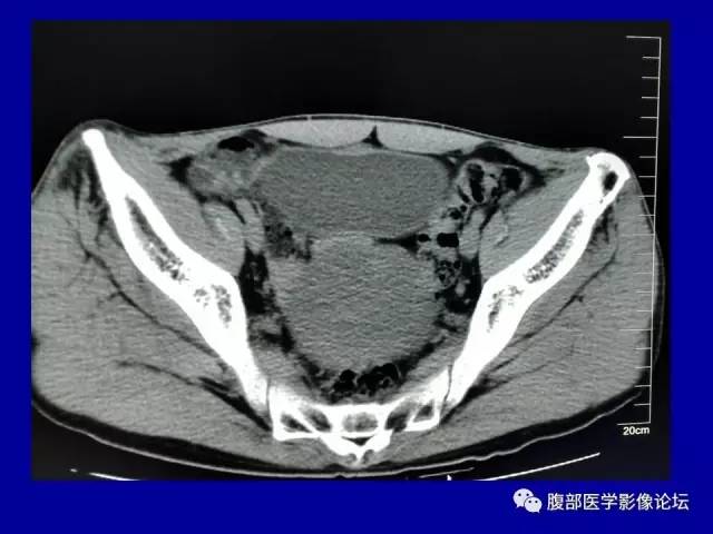 【病例】盆腔胃肠道间质瘤1例CT影像表现 【病例】盆腔胃肠道间质瘤1例CT影像表现