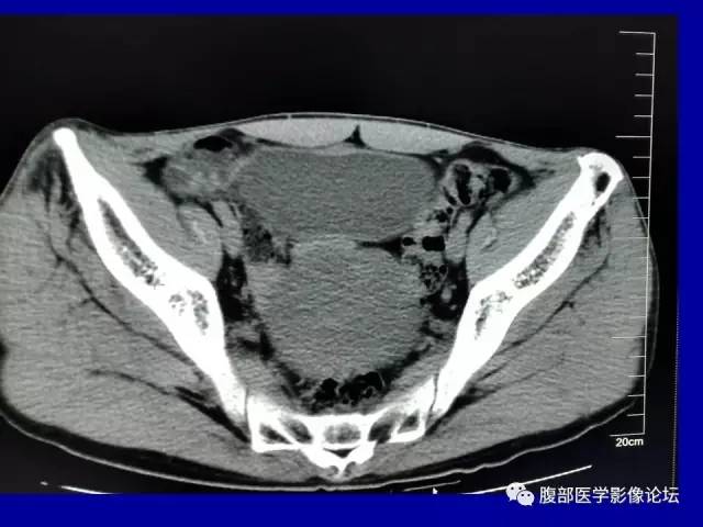 【病例】盆腔胃肠道间质瘤1例CT影像表现 【病例】盆腔胃肠道间质瘤1例CT影像表现