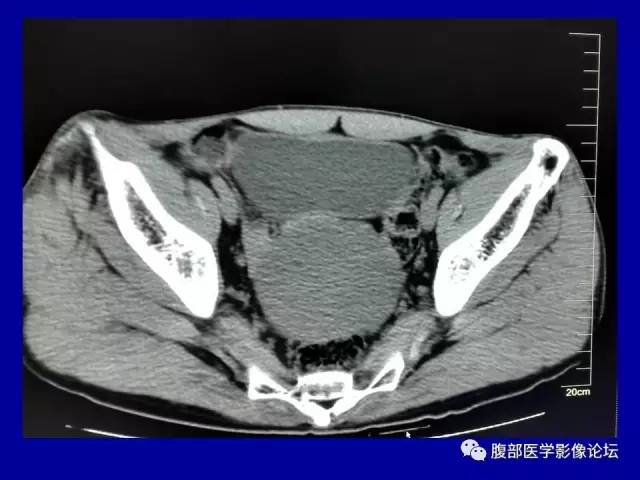 【病例】盆腔胃肠道间质瘤1例CT影像表现 【病例】盆腔胃肠道间质瘤1例CT影像表现