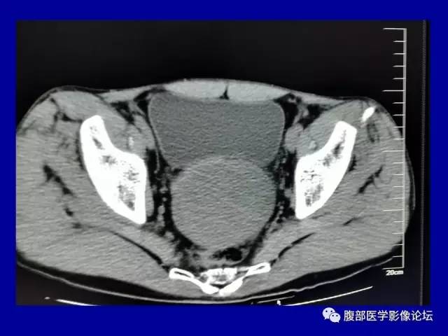 【病例】盆腔胃肠道间质瘤1例CT影像表现 【病例】盆腔胃肠道间质瘤1例CT影像表现