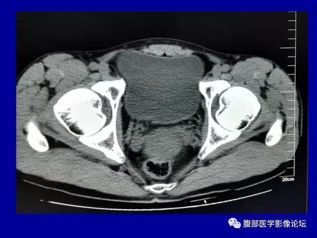 【病例】盆腔胃肠道间质瘤1例CT影像表现 【病例】盆腔胃肠道间质瘤1例CT影像表现