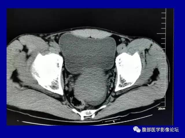 【病例】盆腔胃肠道间质瘤1例CT影像表现 【病例】盆腔胃肠道间质瘤1例CT影像表现