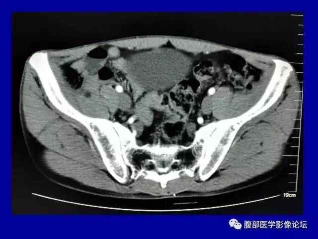 【病例】盆腔胃肠道间质瘤1例CT影像表现 【病例】盆腔胃肠道间质瘤1例CT影像表现