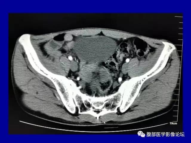 【病例】盆腔胃肠道间质瘤1例CT影像表现 【病例】盆腔胃肠道间质瘤1例CT影像表现