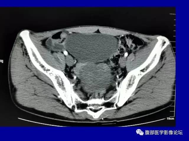 【病例】盆腔胃肠道间质瘤1例CT影像表现 【病例】盆腔胃肠道间质瘤1例CT影像表现