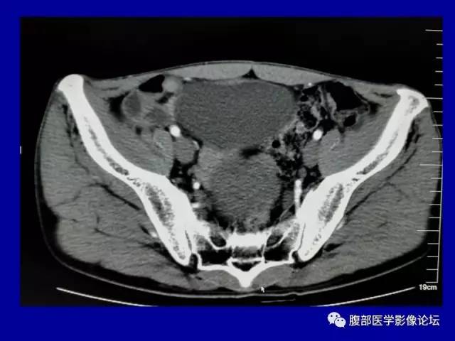 【病例】盆腔胃肠道间质瘤1例CT影像表现 【病例】盆腔胃肠道间质瘤1例CT影像表现