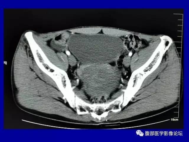 【病例】盆腔胃肠道间质瘤1例CT影像表现 【病例】盆腔胃肠道间质瘤1例CT影像表现
