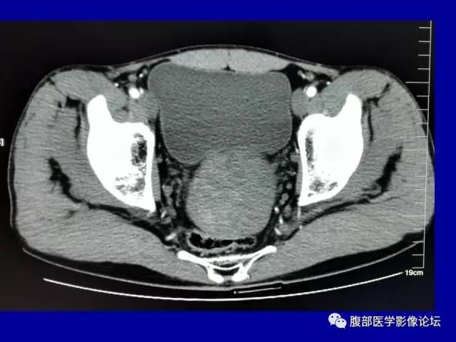【病例】盆腔胃肠道间质瘤1例CT影像表现 【病例】盆腔胃肠道间质瘤1例CT影像表现