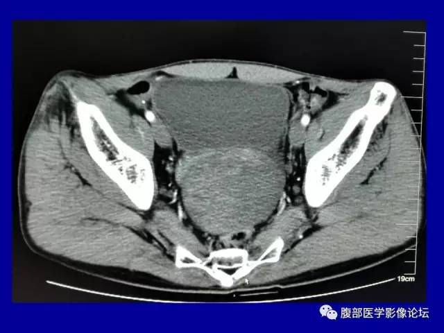 【病例】盆腔胃肠道间质瘤1例CT影像表现 【病例】盆腔胃肠道间质瘤1例CT影像表现