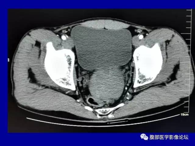 【病例】盆腔胃肠道间质瘤1例CT影像表现 【病例】盆腔胃肠道间质瘤1例CT影像表现
