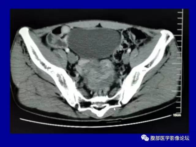 【病例】盆腔胃肠道间质瘤1例CT影像表现 【病例】盆腔胃肠道间质瘤1例CT影像表现