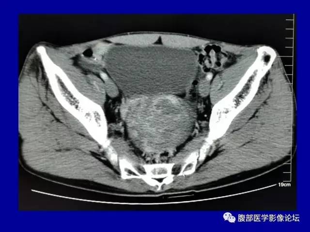 【病例】盆腔胃肠道间质瘤1例CT影像表现 【病例】盆腔胃肠道间质瘤1例CT影像表现