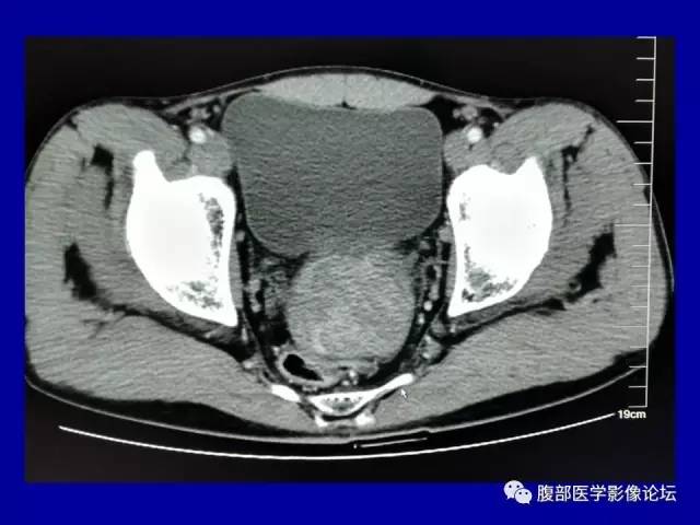 【病例】盆腔胃肠道间质瘤1例CT影像表现 【病例】盆腔胃肠道间质瘤1例CT影像表现