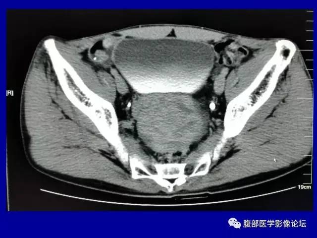 【病例】盆腔胃肠道间质瘤1例CT影像表现 【病例】盆腔胃肠道间质瘤1例CT影像表现