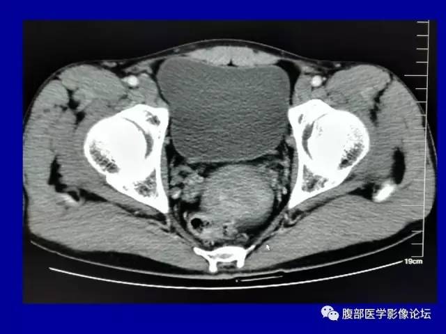 【病例】盆腔胃肠道间质瘤1例CT影像表现 【病例】盆腔胃肠道间质瘤1例CT影像表现