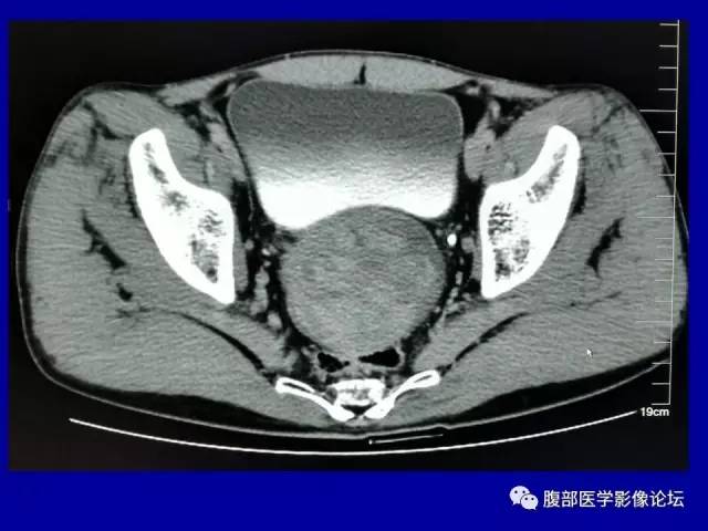 【病例】盆腔胃肠道间质瘤1例CT影像表现 【病例】盆腔胃肠道间质瘤1例CT影像表现