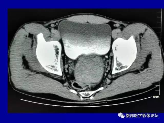 【病例】盆腔胃肠道间质瘤1例CT影像表现 【病例】盆腔胃肠道间质瘤1例CT影像表现