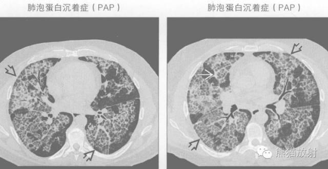 【书摘】“铺路石征”的鉴别诊断