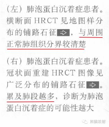 【书摘】“铺路石征”的鉴别诊断