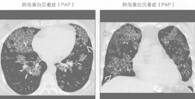 【书摘】“铺路石征”的鉴别诊断