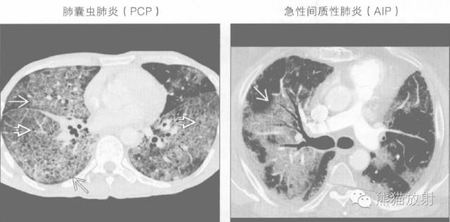 【书摘】“铺路石征”的鉴别诊断