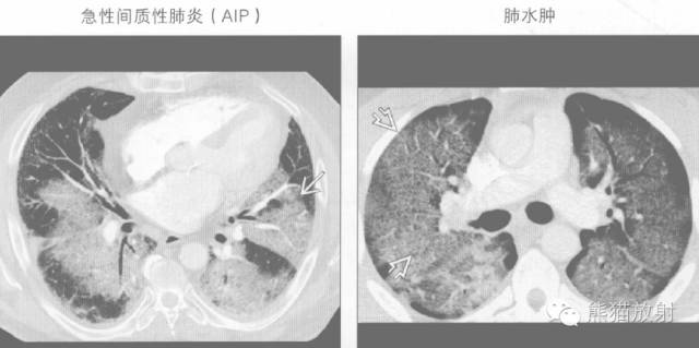 【书摘】“铺路石征”的鉴别诊断