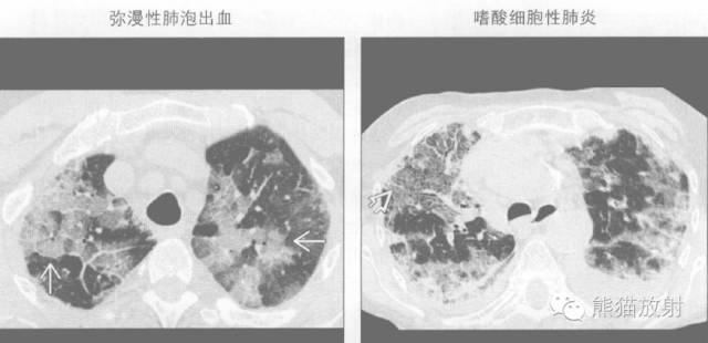 【书摘】“铺路石征”的鉴别诊断