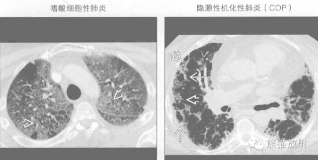 【书摘】“铺路石征”的鉴别诊断