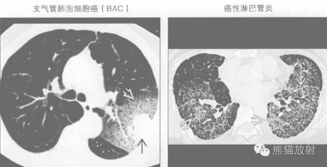 【书摘】“铺路石征”的鉴别诊断
