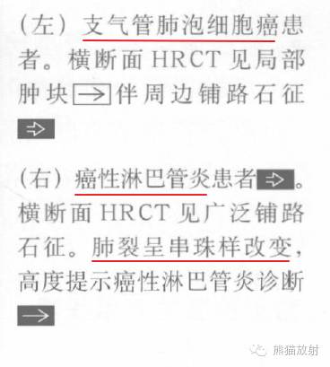 【书摘】“铺路石征”的鉴别诊断