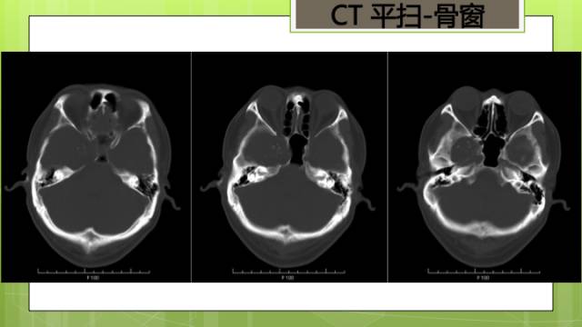 【病例】右侧海绵窦旁不典型神经鞘瘤1例CT及MR影像表现