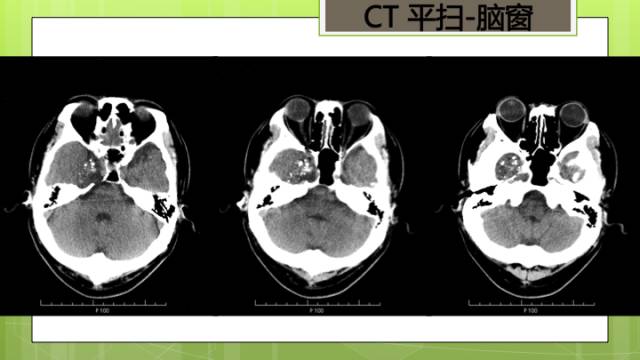 【病例】右侧海绵窦旁不典型神经鞘瘤1例CT及MR影像表现