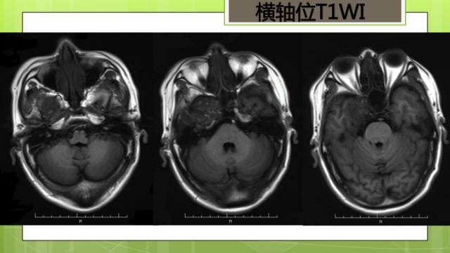 【病例】右侧海绵窦旁不典型神经鞘瘤1例CT及MR影像表现