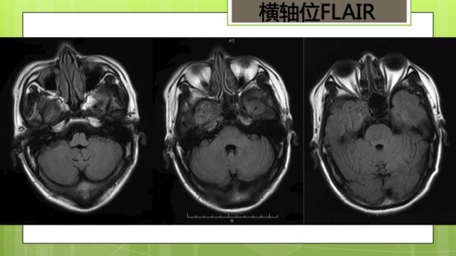 【病例】右侧海绵窦旁不典型神经鞘瘤1例CT及MR影像表现