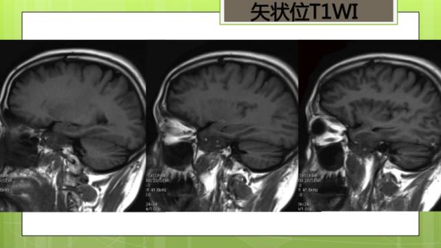【病例】右侧海绵窦旁不典型神经鞘瘤1例CT及MR影像表现