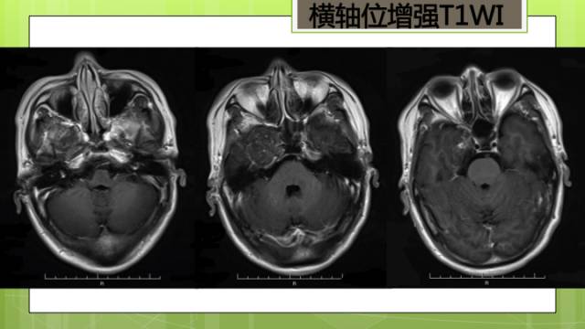 【病例】右侧海绵窦旁不典型神经鞘瘤1例CT及MR影像表现