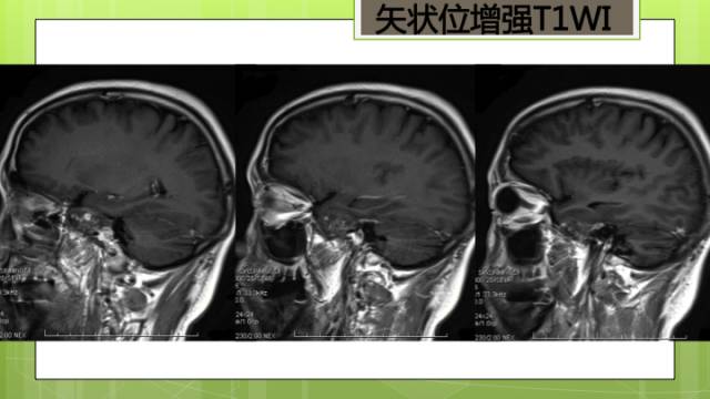 【病例】右侧海绵窦旁不典型神经鞘瘤1例CT及MR影像表现