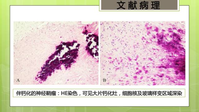 【病例】右侧海绵窦旁不典型神经鞘瘤1例CT及MR影像表现