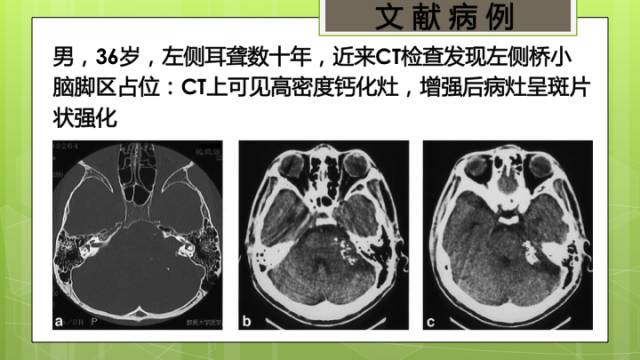 【病例】右侧海绵窦旁不典型神经鞘瘤1例CT及MR影像表现