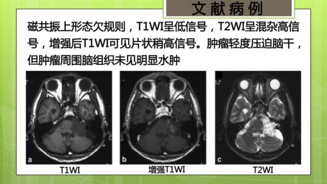 【病例】右侧海绵窦旁不典型神经鞘瘤1例CT及MR影像表现
